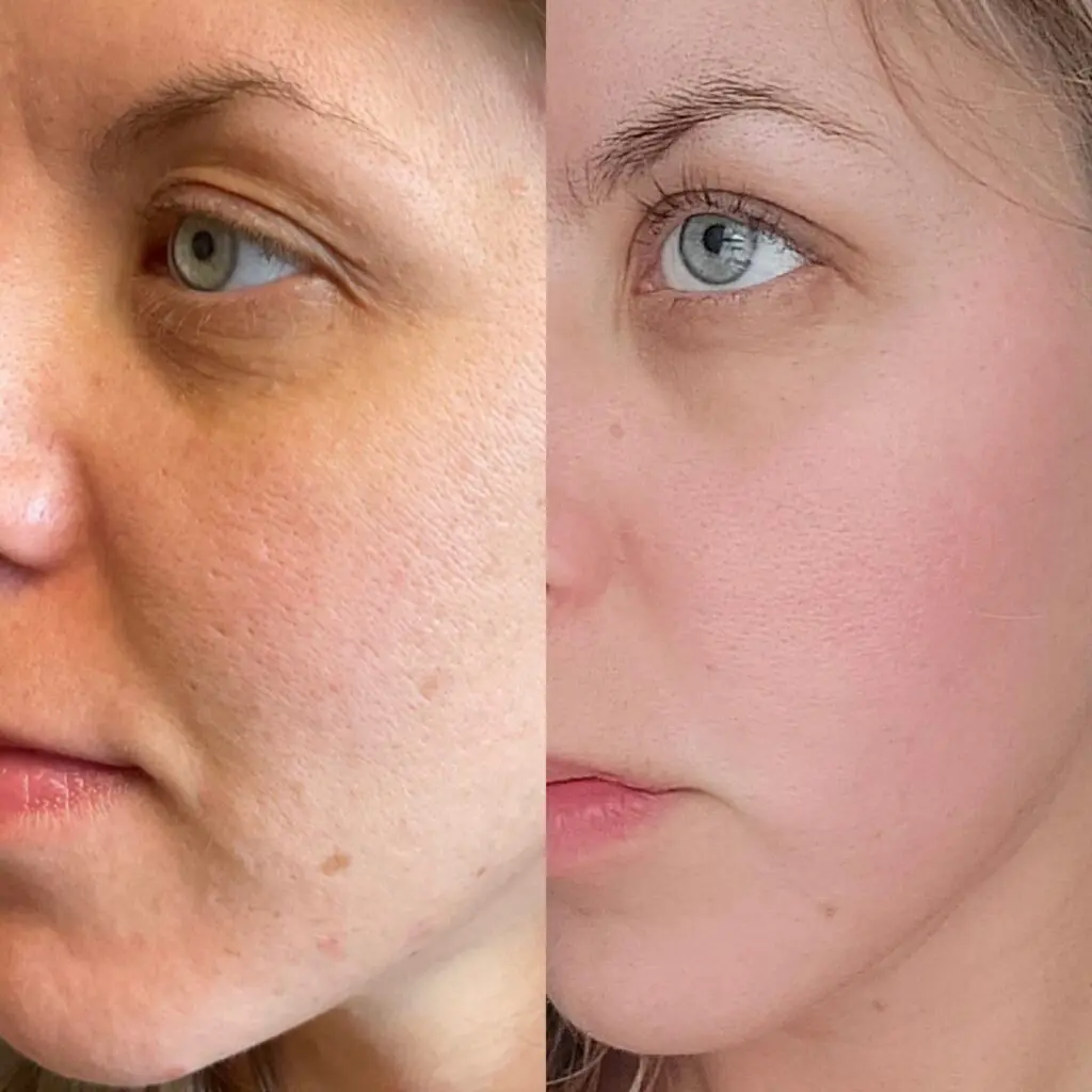 this picture is showing a before and after of a moxi treatment. she has blonde hari and blue eyes and is absolutley stunning. her after picture is really nice. 