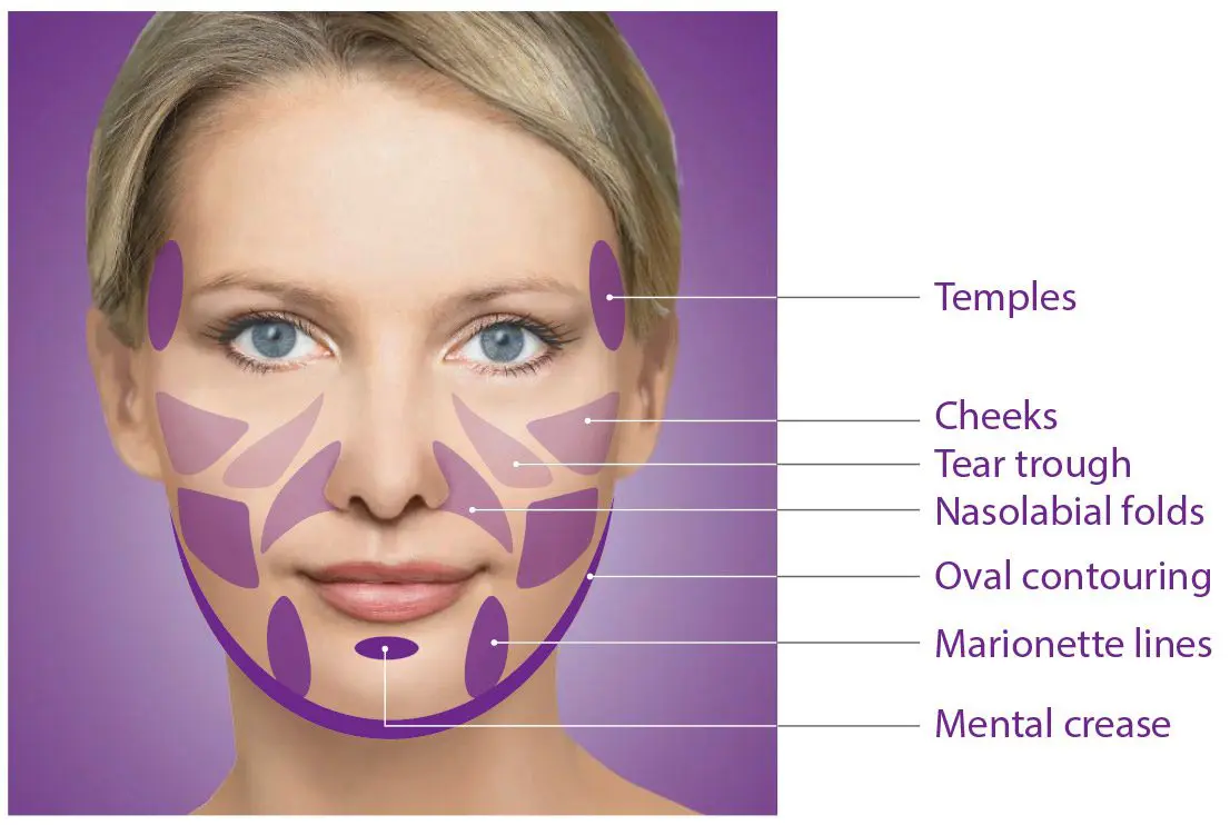 face of a woman which highlights areas that can be injected with sculptra aesthetic.