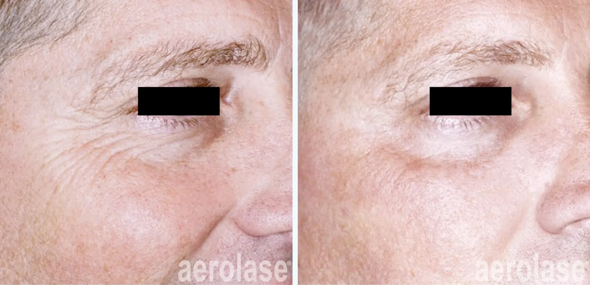 crows feet treated by neo laser