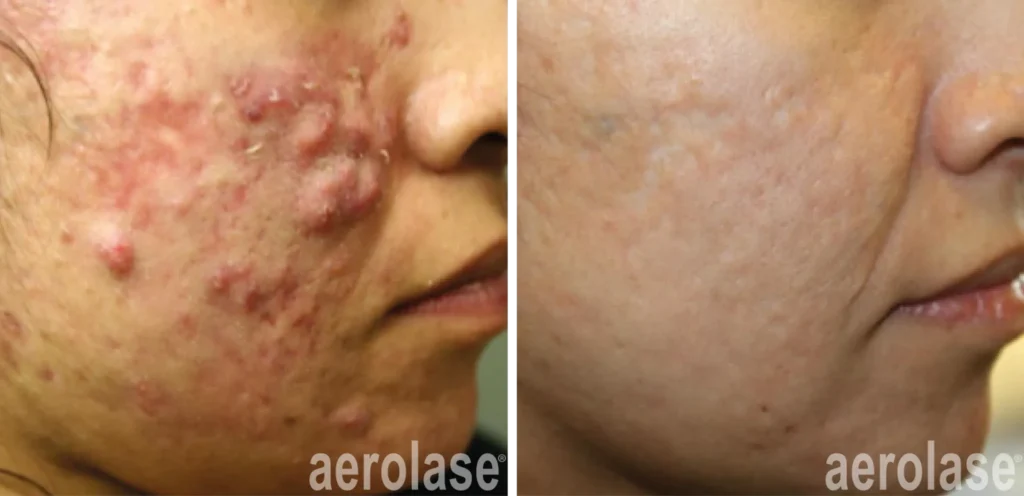 cystic acne treatment columbia md