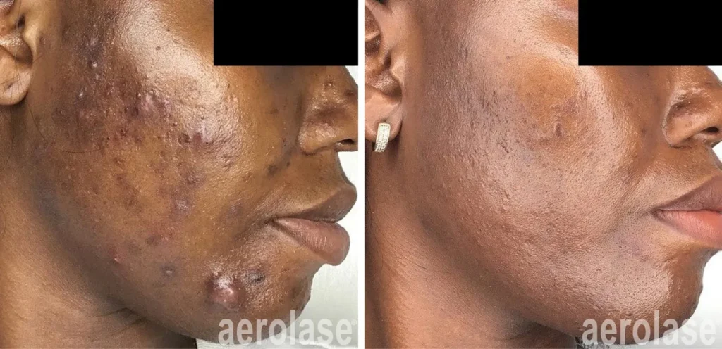 acne treatment skin of color