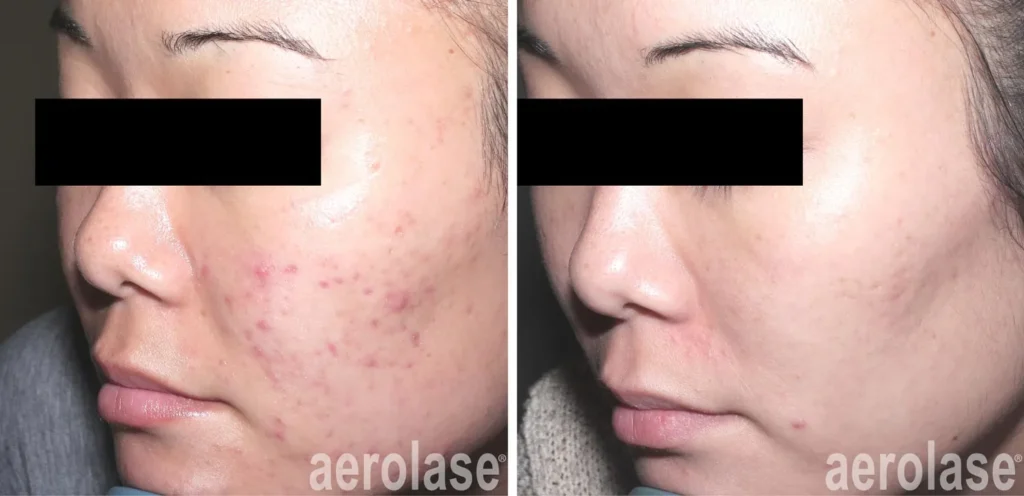 acne treatment asian skin