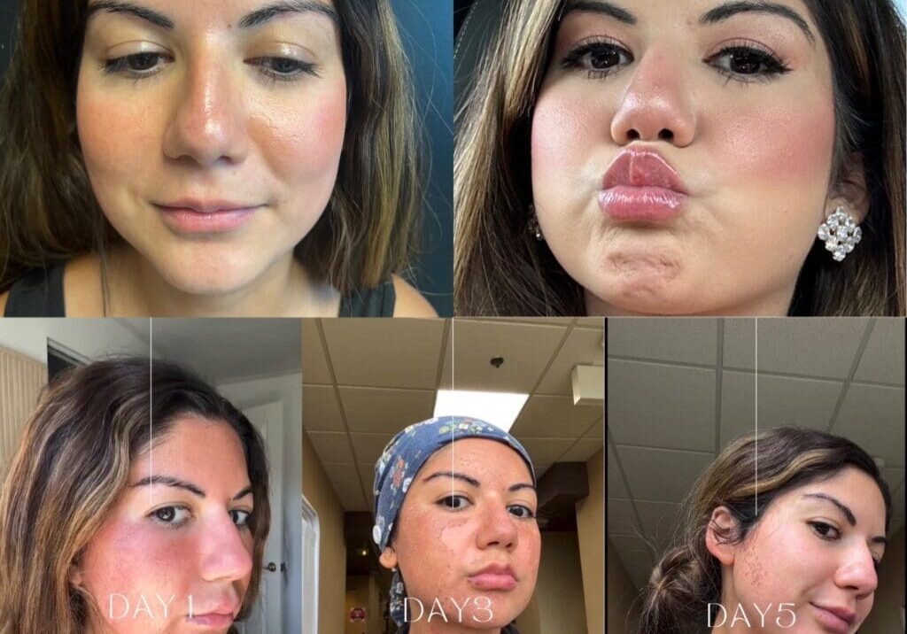 Before-and-after facial treatment healing progress collage