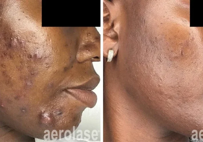 acne treatment skin of color